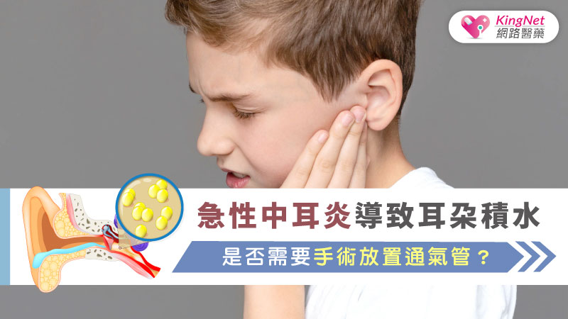 急性中耳炎導致耳朵積水，是否需要手術放置通氣管？